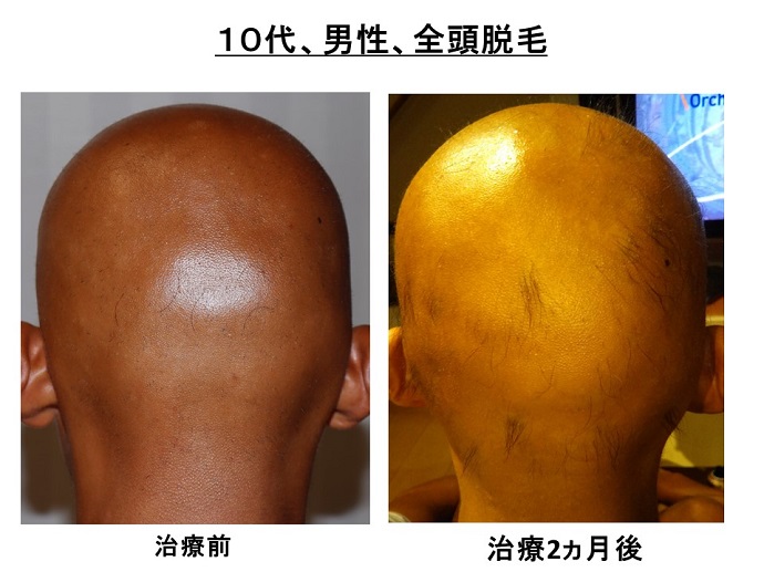 円形脱毛症　病院